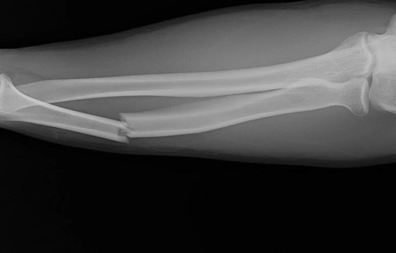 Broken arm x ray image 1